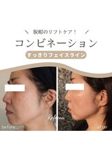 クリニカルエステ リフィーナ 辻堂店/小顔リフトの速効性◎