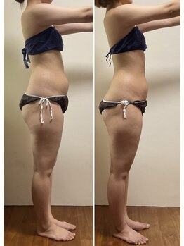 ニコワ(Nicowa)/Nicowaの痩身★BeforeAfter