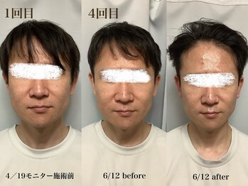 ブプラ 小倉店(BUPURA)/小顔になりたい方必見!