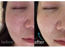 ルーム701(room701)/小顔リフトアップフェイスライン