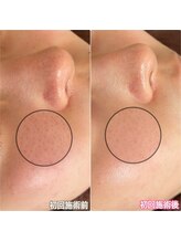エクレット/【毛穴引き締め特化】お客様変化