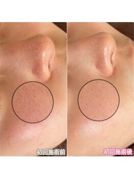 エクレット/【毛穴引き締め特化】お客様変化