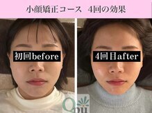 キュープ 福岡九大学研都市店(Qpu)/小顔矯正コース４回の変化