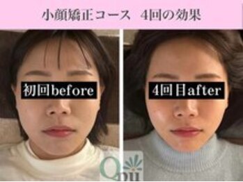 キュープ 福岡九大学研都市店(Qpu)/小顔矯正コース４回の変化