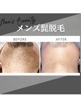ルナベル(Luna Bell)/メンズ髭脱毛