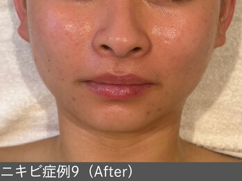 オアシスラグーン(OASIS LAGOON)/ニキビ改善(症例9 after)