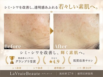 ラヴレボーテ(La Vraie Beaute)の写真/◆シミ・しわ改善 増え続けるトラブルに終止符を…年齢を感じさせないエイジングケアフェイシャル◆