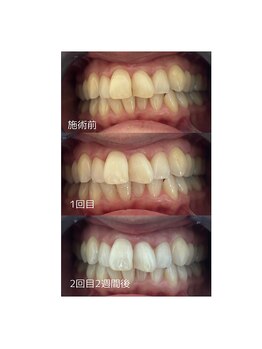 アトレ(Attrait)/黄ばみなし!LEDホワイトニング