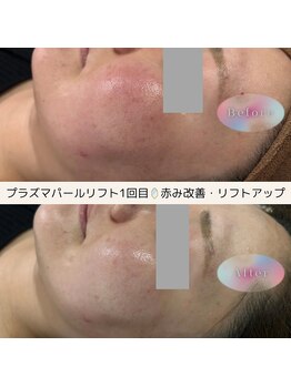 ディアー(Dear)/プラズマパールリフト