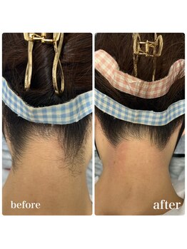 サロン ラズリ 久留米店(SALON Lazuli)/【うなじ脱毛】光/ワックス可