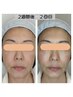 【50代のお悩み】ハリ・つや再生フェイシャル集中ケア3回　￥36000