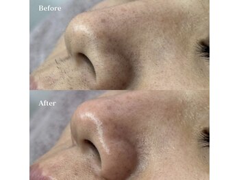 ホワイトワックス 浜松(WHITE WAX)/小鼻周りもつるんと仕上がる