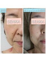 奏美/光フェイシャル