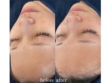 リーミー(Re:me)/ラミネーションピールコース