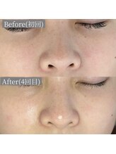 ホワイトアクア 鳳店(WHITE AQUA)/ララピール/大阪/鳳/毛穴/ツヤ肌