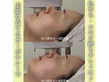 ハニエル(Haniel)/カーボキシー症例