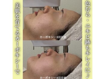 ハニエル(Haniel)/カーボキシー症例