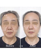 ジェイミープラス 表参道(J‘aimee +)/小顔矯正・リフトアップ