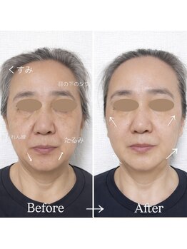 ジェイミープラス 表参道(J‘aimee +)/小顔矯正・リフトアップ