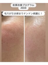 スリーピングビューティー(Sleeping Beauty)/しわ、たるみ改善