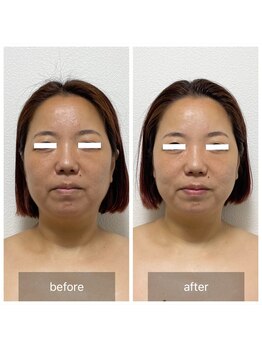 メロウゴールド(Mellow Gold)/WINBACK小顔×ハーブピーリング