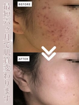 モモ(momo)/最短半年でこの変化！！