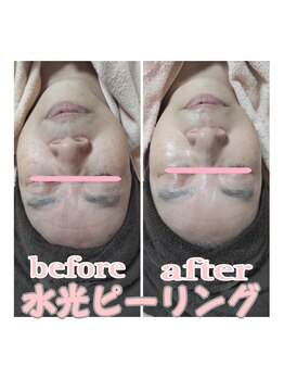 ピュルテ/水光ピーリングでゆるみ退治!