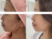 サクラ 伊勢原店(SAKURA)/フェイシャルエステ以上の効果
