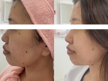 サクラ 伊勢原店(SAKURA)/フェイシャルエステ以上の効果