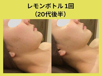 アユアラングレース/レモンボトル1回