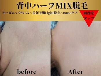 ベルアンドヘルス 千葉(BELL&HEALTH)/背中MIX脱毛で360°綺麗を極める