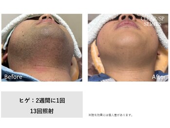 ニューバーバー キローゼ(NEW BARBER Ki.ROSE)/ヒゲ脱毛13回