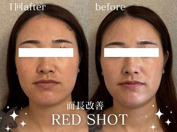 グランクウォーレ(Gran Cuore)/脂肪にアプローチ！