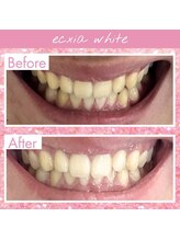 エクシアホワイトニング 稲沢店/お客様ビフォーアフター