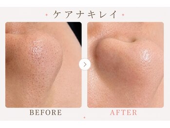 パールプラス 大田原店(Pearl plus)/毛穴の黒ずみケア