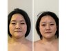 【超小顔コース】小顔矯正×フェイシャルハイパーナイフEX×表情筋リンパ75分