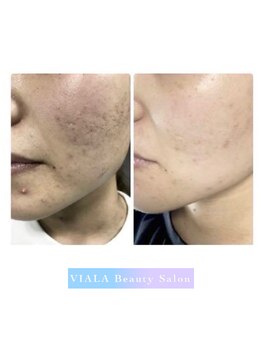 ビアラ(VIALA)/プラズマのBefore/After