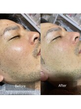 セメ(S’aimer)/ハーブピーリング