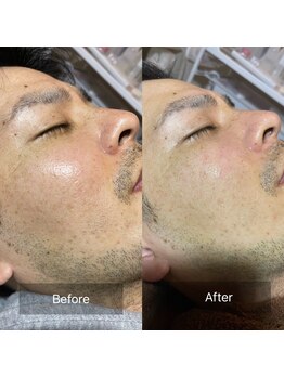 セメ(S’aimer)/ハーブピーリング