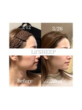 リルシープ(LIL'SHEEP)/眠れる小顔コルギ3回施術