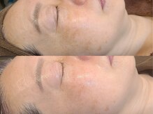 ブラン(BLANC)/<一番人気>新水光ピール