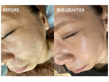 フィズ 海老名店(FIS)/☆ハーブピーリング☆都度払い