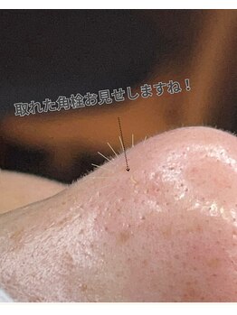 スパークル/毛穴/角栓/詰まり