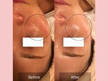 アメリイ 百合ヶ丘 新百合ヶ丘(Amerii)/シミ/エイジングケア/美白