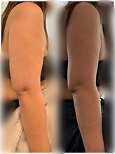 ドゥーソル 谷町四丁目店(due sole)/【痩せにくい二の腕】脂肪冷却