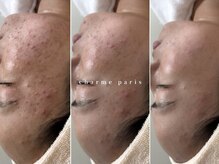 シャルムパリス(charme paris)の雰囲気（【原因分析が得意です】ニキビ/ホルモンバランス/食生活/毛穴）