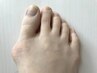 【初回】外反母趾　足の親指の歪み矯正片足  初回40分¥6,600