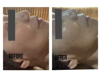 ザ ワン(THE ONE)/シワケア 筋骨小顔 幹細胞導入