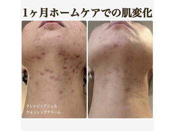 エステサロンブランシュ(Esthe salon Blanche)/ルヴィ化粧品でニキビケア