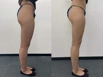 オリス(ORRIS)/ビフォーアフター(脚・お尻)